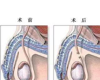 卵巢囊肿可以做供卵做试管婴儿吗