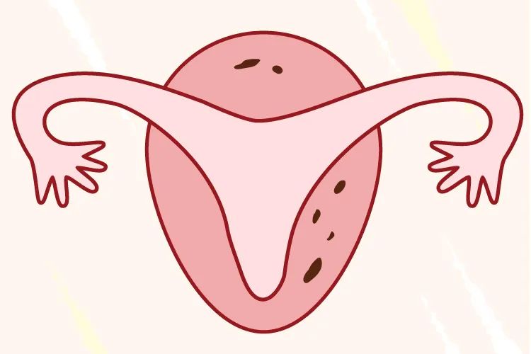 月经推迟是卵巢早衰的症状吗